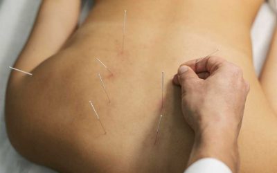Can Acupuncture Help With Diabetic Neuropathy?